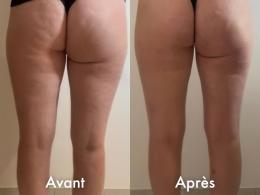 Avant Après NeoCare