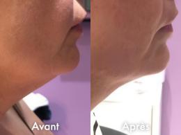 Avant Après NeoCare