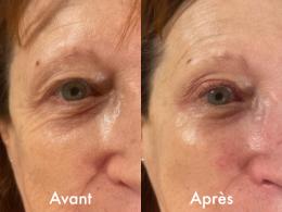 Avant Après NeoCare
