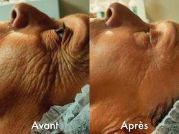 Avant Après NeoCare
